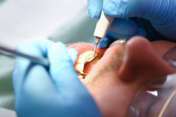 Best Emergency Wisdom Teeth Removal in Ttapoisett Center, MA